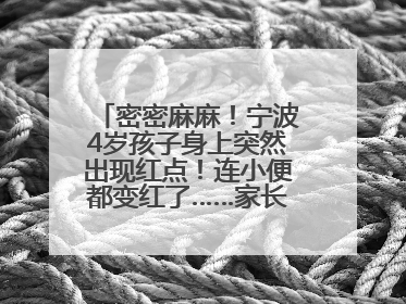 密密麻麻！宁波4岁孩子身上突然出现红点！连小便都变红了……家长：以为只是摔伤